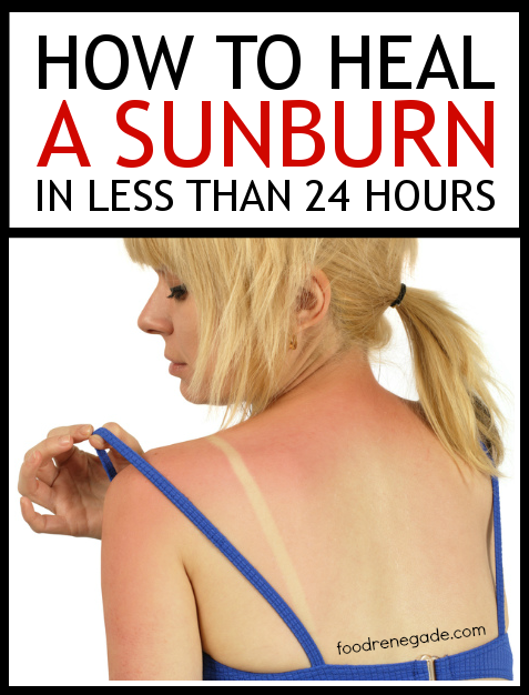 How to Heal a Sunburn In Less Than 24 Hours